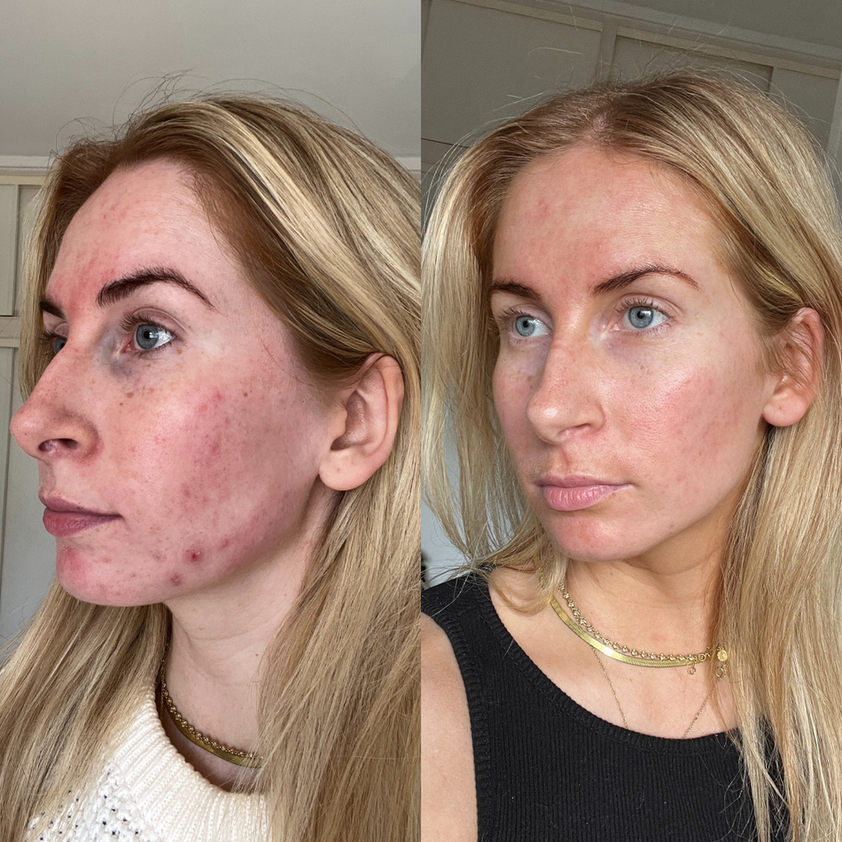 Using Self Tan on the Face with AcneProne Skin Luna Bronze